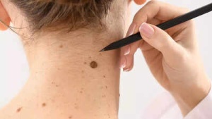 Subtle Signs of Melanoma: Experts Warn of Overlooked Skin Cancer Risks
