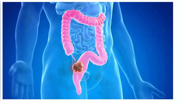 Image depicting weight loss, a potential symptom of colon cancer