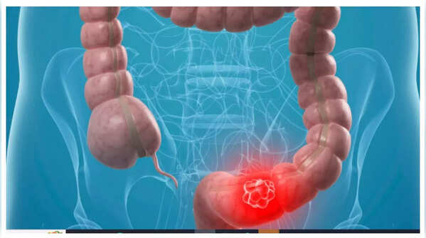 Illustration of abdominal pain, a symptom of colon cancer