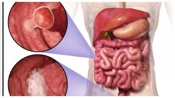 Image depicting blood in stool, a potential sign of colon cancer